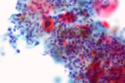 【海外】「たった6週間で腫瘍を縮小！頭頸部がん患者に希望の新薬試験」