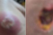 寝ている間に“勝手に施術”で皮膚壊死…韓国で怒り噴出、「無資格で人体いじるな」の声が殺到