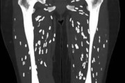 海外の反応　生焼けの豚肉を食べた人の衝撃のＣＴ画像