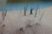 海外「日本の科学者が毛髪再生の画期的な手法を開発。ハゲネズミに毛を生やすことに成功」