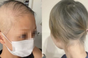 【韓国の反応】ワクチンを打って髪の毛と眉毛が全部抜けた…日本の女性の近況。韓国の反応「日本政府とマスコミは隠そうとしている。」