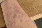 海外「初めてバレーボールしたら腕がこんな風になったんだが、これ正常なのか？」