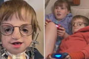 【海外】自分の肋骨を使って男の子の顎を再建！呼吸と食事が自力でできるように復活した奇跡の手術