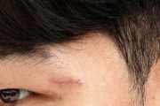 【W杯】韓国人「ガーナ戦後、ソン・フンミンの顔の傷が悪化してしまう‥（ﾌﾞﾙﾌﾞﾙ」現在の傷口の状態がこちら‥　韓国の反応