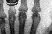 【世界初のX線写真、実は別人の手?】海外「妻で放射線実験とは」→「その執念に感謝すべき」
