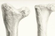【海外】「科学者が発見！骨を強くするスイッチで、 osteoporosis（骨粗しょう症）を防ぐ新しい希望」