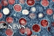 米：わずか一日で「サル痘」感染者が1000名を超す…流行が急加速[海外の反応]