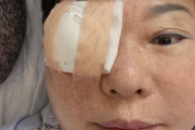 韓国人「片目を覆い『寝ていなければならない』…ヤン・ヒウンが受けた『角膜移植』はどんな手術？」と話題に