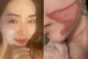 「600ショットで顔が裂ける痛み」韓国で元アイドルが“リフティング施術のやけど”を告白、反応は真っ二つ