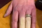 海外「私もこの症状が出るよ…」手足が真っ白になって感覚を失う『レイノー現象』