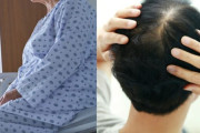 韓国人「脱毛症の健康保険適用に重症患者が裏切られた気持ち…生命に関わる治療は後回しか」と怒りの声